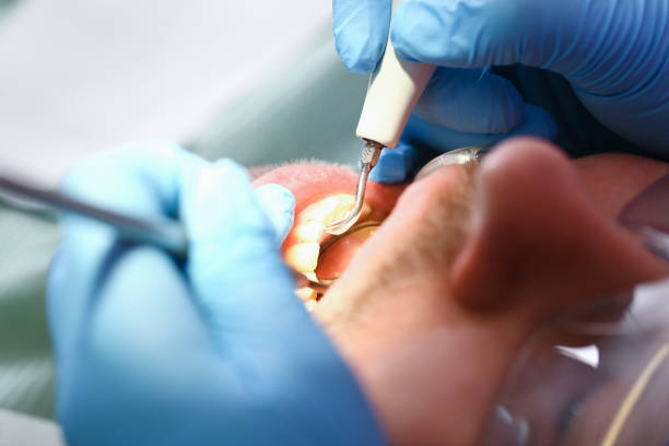 Best Emergency Dentist for Lost Fillings or Crowns in Tangent, OR